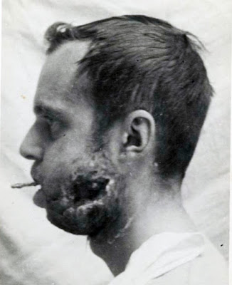 Le-lieutenant-Paul-Rogez-grievement-blesse-par-une-balle-dans-la-machoire-Paris-25-aout-1944 Le lieutenant Paul Rogez grièvement blessé par une balle dans la mâchoire, Paris 25 août 1944